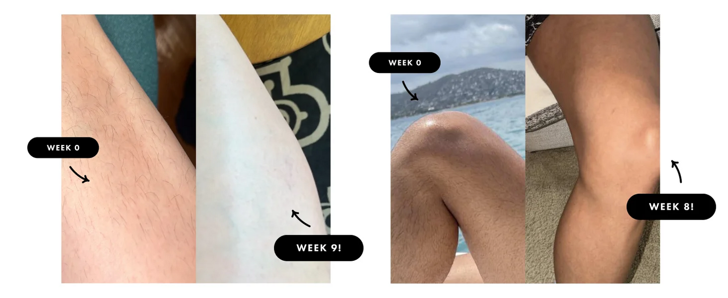 IPL Hair Removal Laser 999999 Flashes