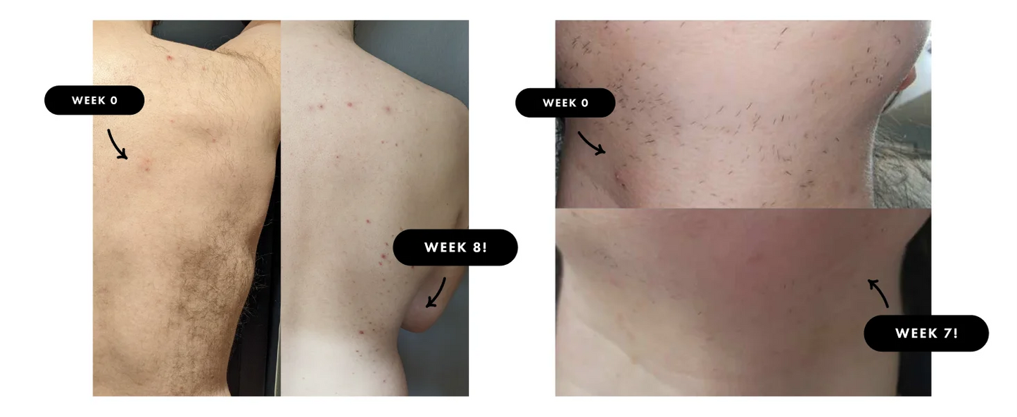 IPL Hair Removal Laser 999999 Flashes
